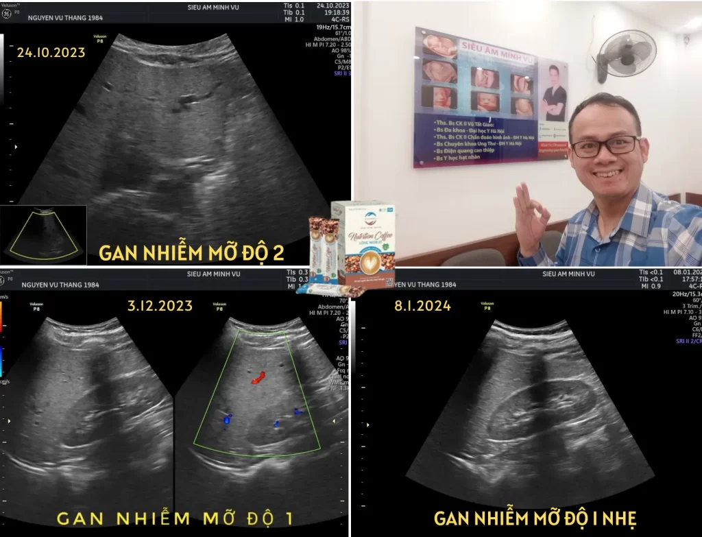 Cải thiện Gan nhiễm mỡ từ độ 2 về bình thường