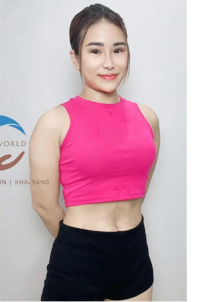 Giảm thành công 15cm mỡ bụng sau sinh, cơ thể nhẹ nhõm tự tin